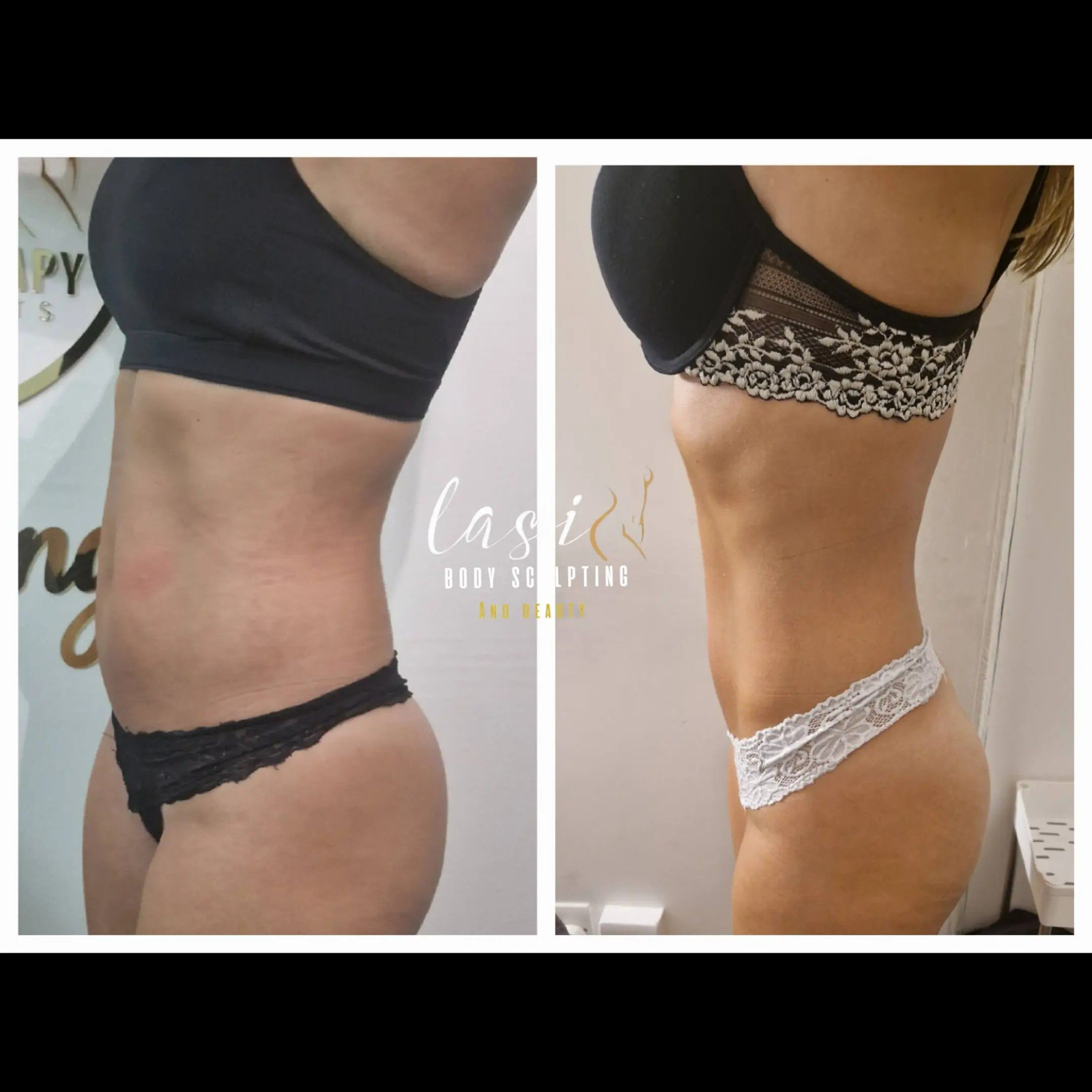 client after powersculpt treatment